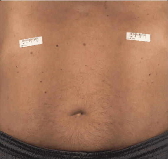 Abdomen of a patient before a HyQvia infusion.