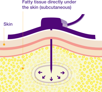 Infusion needle inserted in fatty tissue directly beneath the skin, filled with hyaluronan.