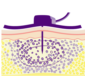 Hy allowing a larger amount of Ig to reach the subQ tissue.