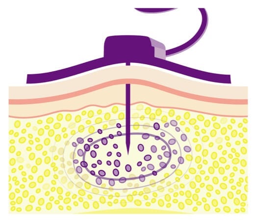 Absence of Recombinant Human Hyaluronidase (Hy) limiting the amount of Ig that can be infused into the subQ tissue.