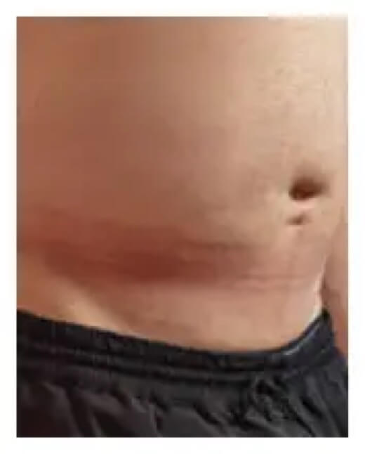 Abdomen of patient 24 hours after a HyQvia infusion.
