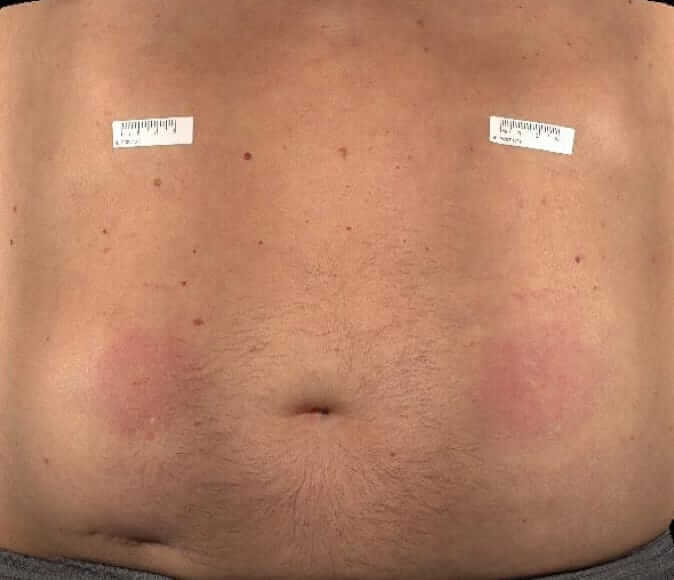 Abdomen of a patient at the end of a HyQvia infusion.