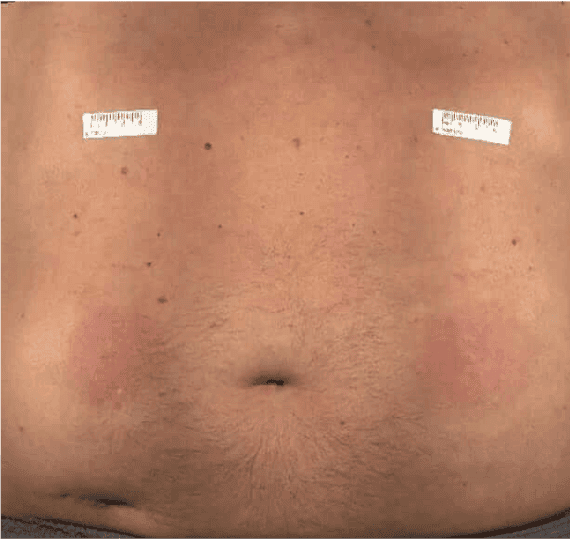 Abdomen of a patient 1-3 days after a HyQvia infusion.
