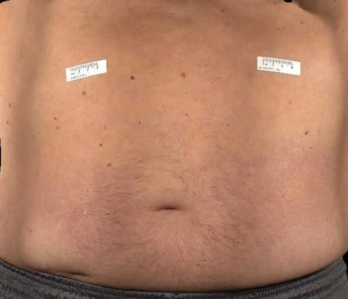 Abdomen of a patient 1-3 days after a HyQvia infusion.