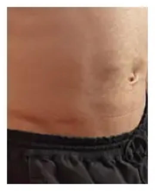 Abdomen of patient at the beginning of a HyQvia infusion.