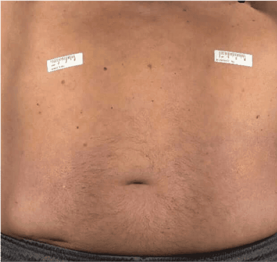 Abdomen of a patient at the end of a HyQvia infusion.