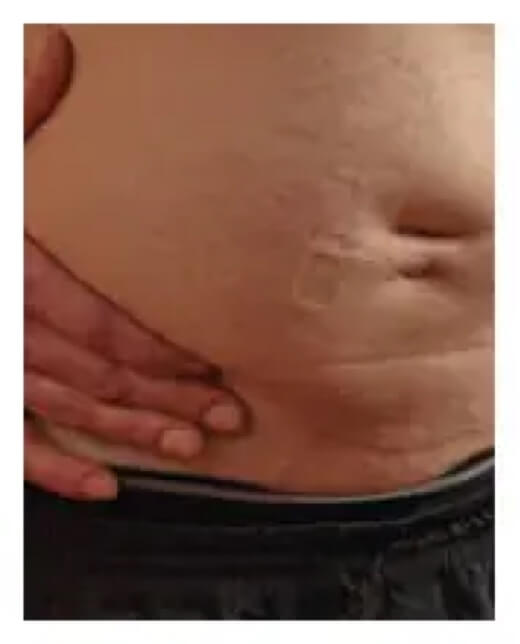 Abdomen of patient at the end of a HyQvia infusion.