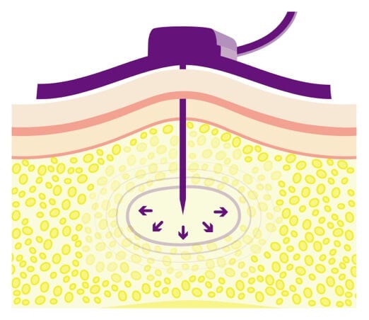 SubQ tissue directly beneath the skin, filled with hyaluronan.