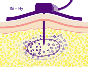 Absence of Recombinant Human Hyaluronidase (Hy), limiting the amount of Ig that can be infused into the subQ tissue.